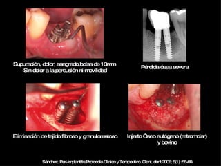 Sánchez. Peri-implantitis Protocolo Clínico y Terapeútico. Cient. dent.2008; 5(1) :55-69. Supuración, dolor, sangrado,bolsa de 13mm  Sin dolor a la percusión ni movilidad Pérdida ósea severa Eliminación de tejido fibroso y granulomatoso Injerto Óseo autógeno (retromolar) y bovino 
