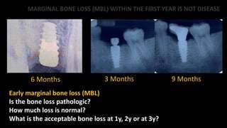6 Months 3 Months 9 Months
MARGINAL BONE LOSS (MBL) WITHIN THE FIRST YEAR IS NOT DISEASE
Early marginal bone loss (MBL)
Is the bone loss pathologic?
How much loss is normal?
What is the acceptable bone loss at 1y, 2y or at 3y?
 