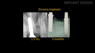 1.5 Yrs 3 months
Zirconia Implants
IMPLANT DESIGN
 