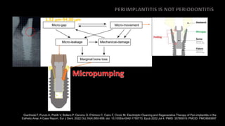 PERIIMPLANTITIS IS NOT PERIODONTITIS
1.52 µm-94.00 µm
Gianfreda F, Punzo A, Pistilli V, Bollero P, Cervino G, D'Amico C, Cairo F, Cicciù M. Electrolytic Cleaning and Regenerative Therapy of Peri-implantitis in the
Esthetic Area: A Case Report. Eur J Dent. 2022 Oct;16(4):950-956. doi: 10.1055/s-0042-1750773. Epub 2022 Jul 4. PMID: 35785819; PMCID: PMC9683897
 