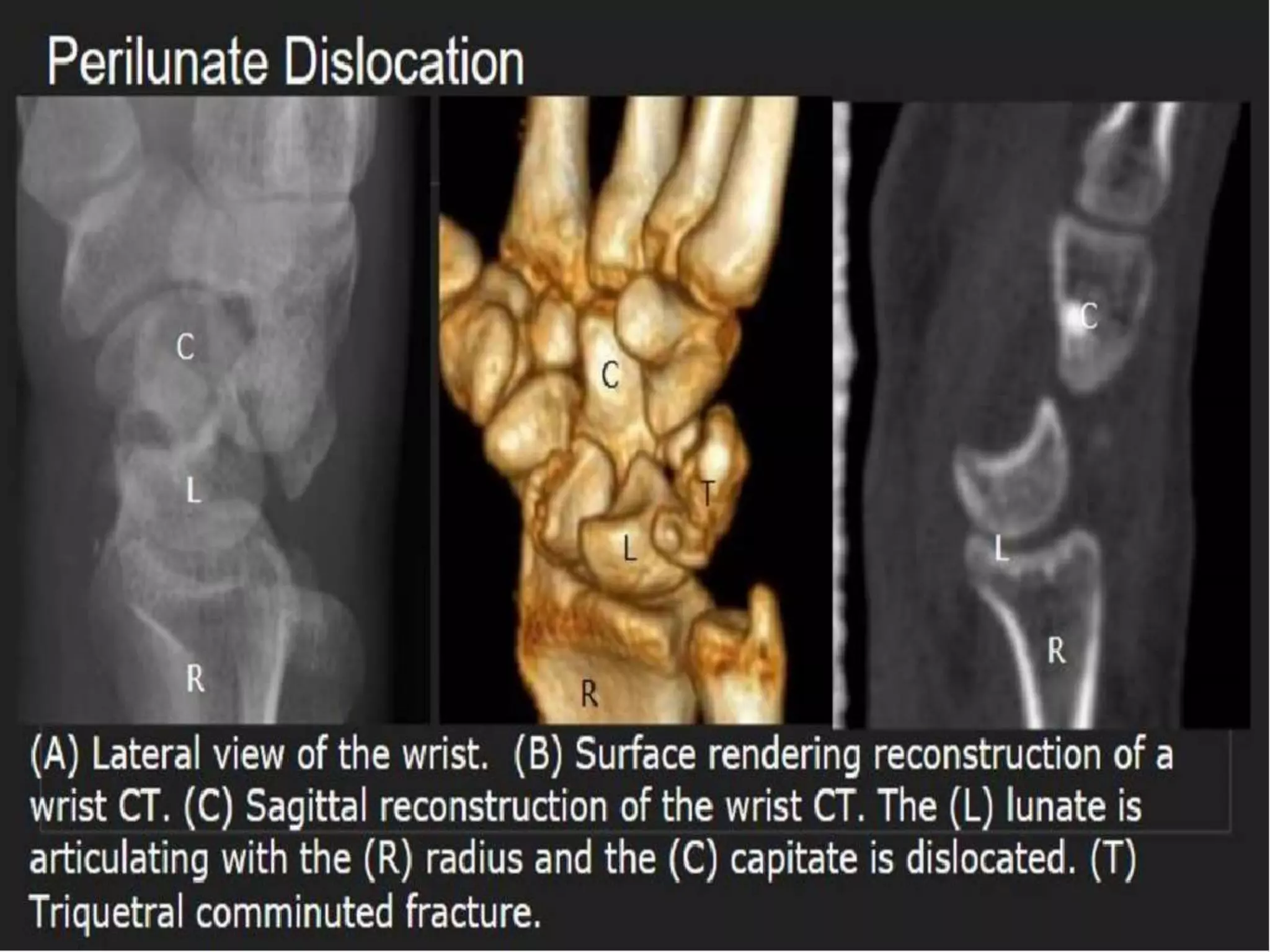 Lunate Fracture & Perilunate dislocation of carpals by Dr.@rpan ...