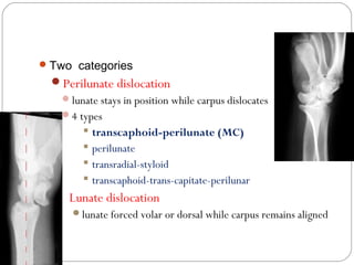 Perilunate dislocations | PPT