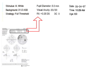 Visual Field Roll Paper Visual field Analysis .ppt