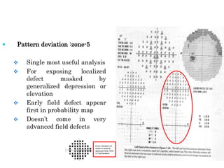 Localized Field Defect Visual field Analysis .ppt