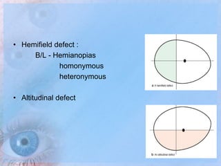 Visual Field Examination | PPTX