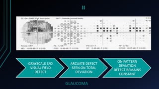 II
GRAYSCALE S/O
VISUAL FIELD
DEFECT
ARCUATE DEFECT
SEEN ON TOTAL
DEVIATION
ON PATTERN
DEVIATION
DEFECT REMAINS
CONSTANT
GLAUCOMA
 