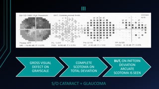 III
GROSS VISUAL
DEFECT ON
GRAYSCALE
COMPLETE
SCOTOMA ON
TOTAL DEVIATION
BUT, ON PATTERN
DEVIATION
ARCUATE
SCOTOMA IS SEEN
S/O CATARACT + GLAUCOMA
 
