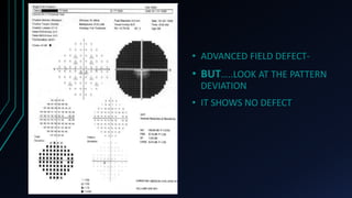 • ADVANCED FIELD DEFECT-
• BUT…..LOOK AT THE PATTERN
DEVIATION
• IT SHOWS NO DEFECT
 