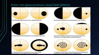 Some non-glaucomatous visual field defects:
 