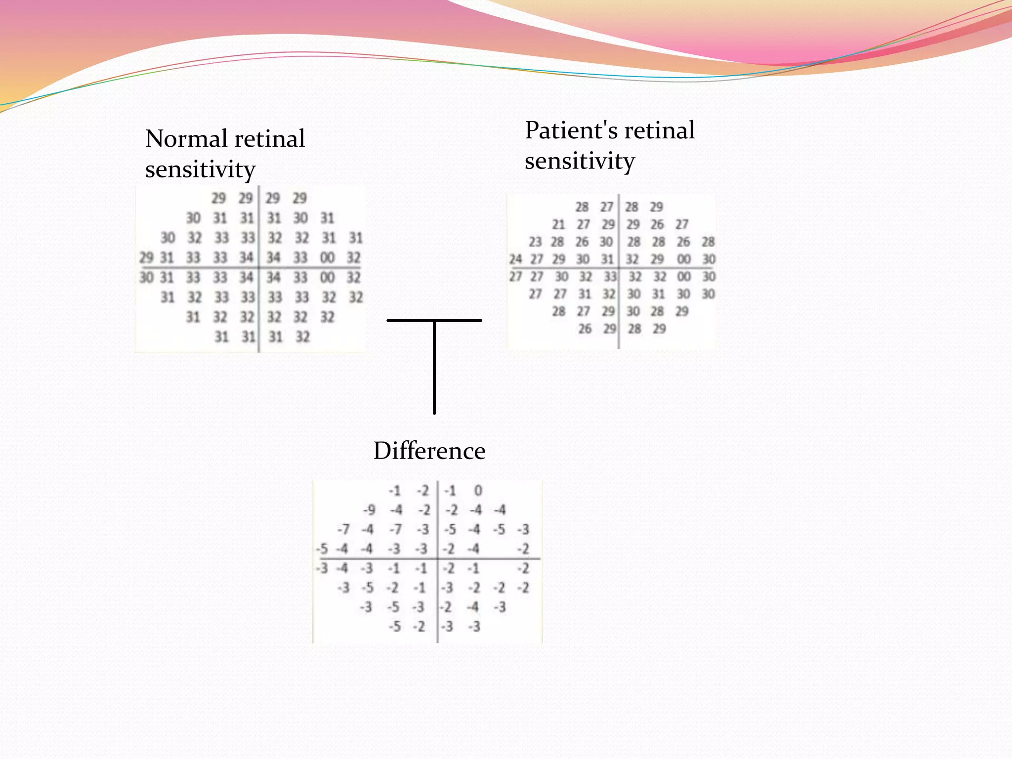 Normal retinal
sensitivity
Patient's retinal
sensitivity
Difference
 