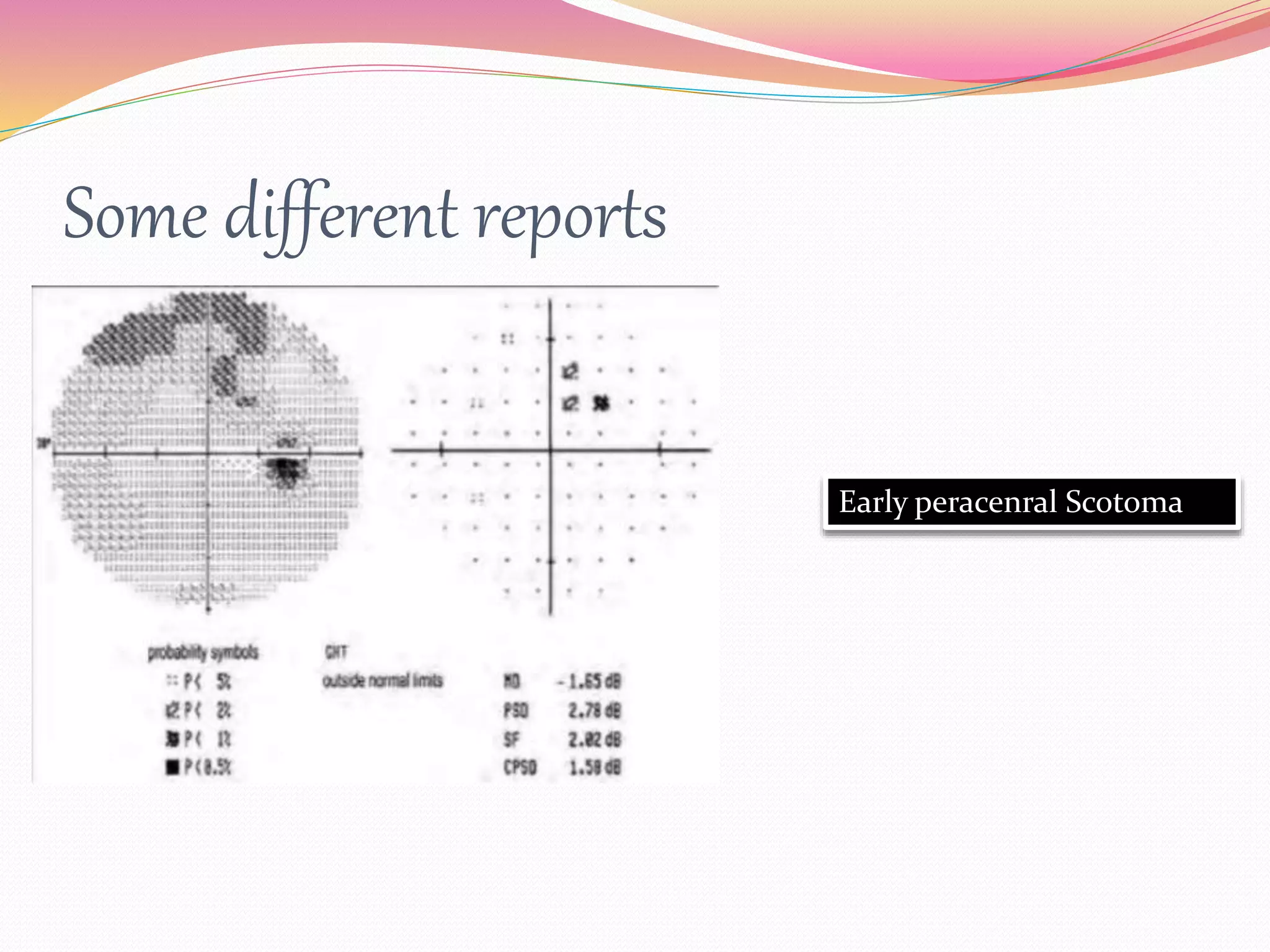 Some different reports
Early peracenral Scotoma
 