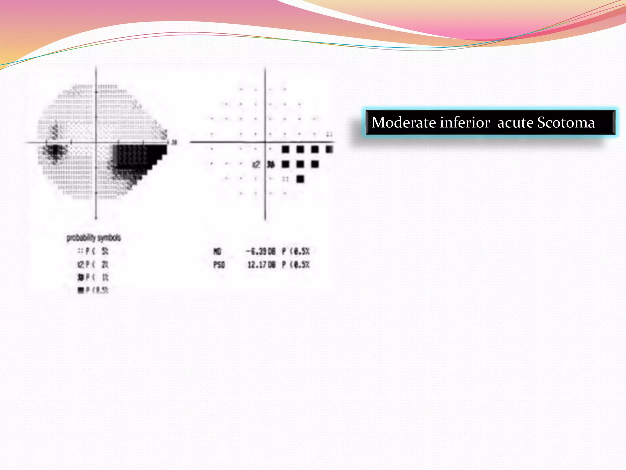 Moderate inferior acute Scotoma
 