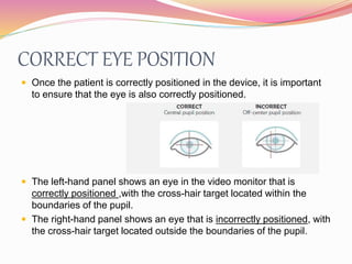 CORRECT EYE POSITION
 Once the patient is correctly positioned in the device, it is important
to ensure that the eye is also correctly positioned.
 The left-hand panel shows an eye in the video monitor that is
correctly positioned ,with the cross-hair target located within the
boundaries of the pupil.
 The right-hand panel shows an eye that is incorrectly positioned, with
the cross-hair target located outside the boundaries of the pupil.
 