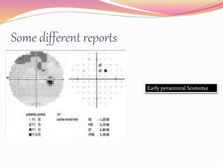 Some different reports
Early peracenral Scotoma
 