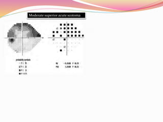 Moderate superior acute scotoma
 