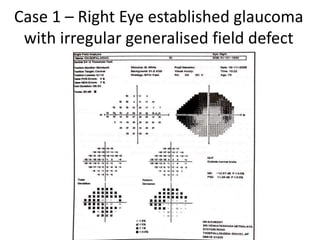 Case 1 – Right Eye established glaucoma
with irregular generalised field defect
 