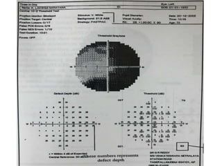 Three in one size V stimulus Printout
 