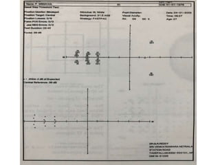 Two in one Nasal Step Printout
 