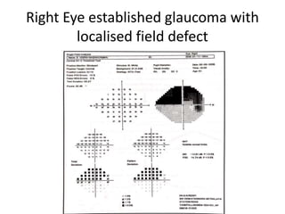 Right Eye established glaucoma with
localised field defect
 