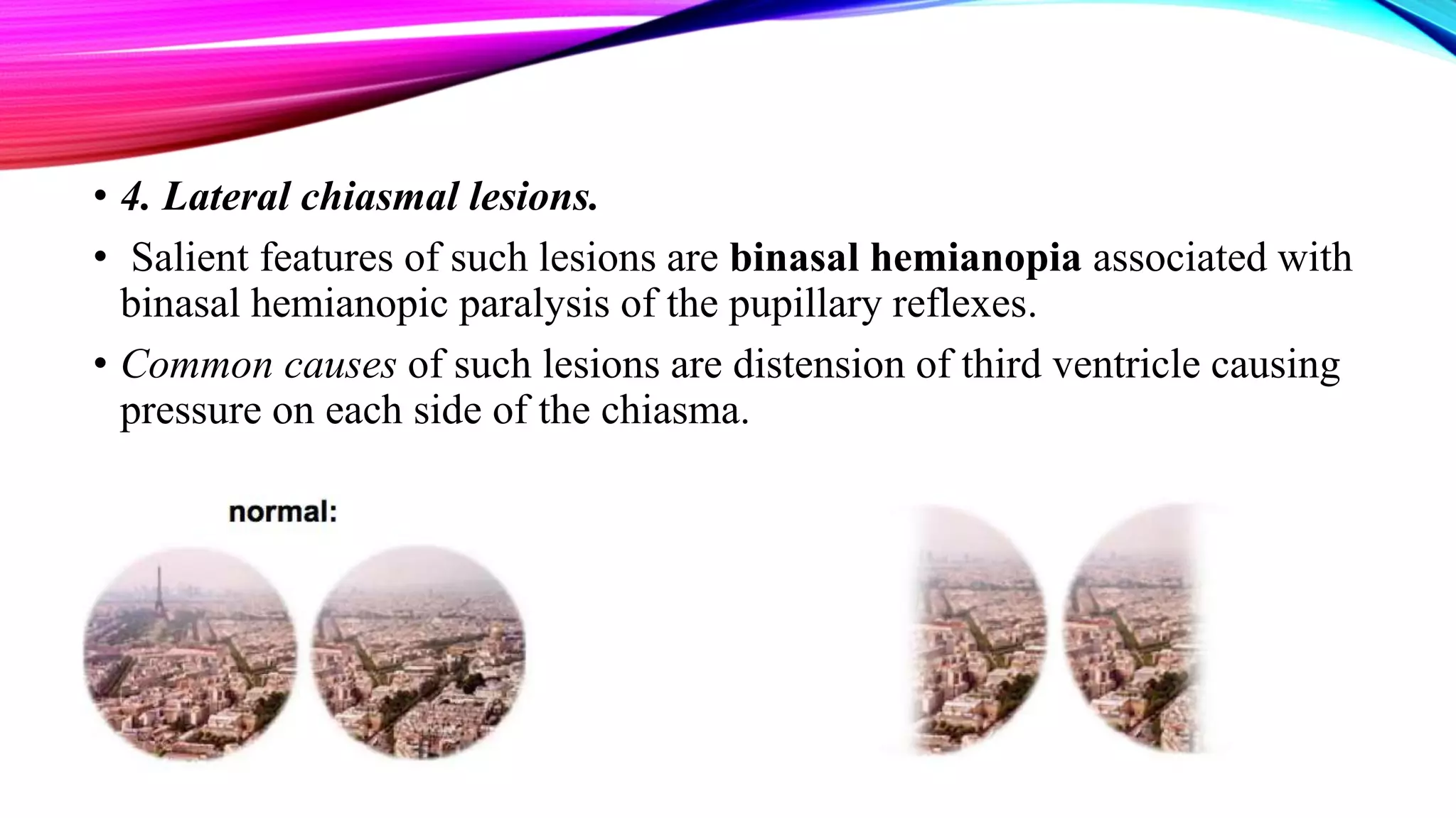• 4. Lateral chiasmal lesions.
• Salient features of such lesions are binasal hemianopia associated with
binasal hemianopic paralysis of the pupillary reflexes.
• Common causes of such lesions are distension of third ventricle causing
pressure on each side of the chiasma.
 