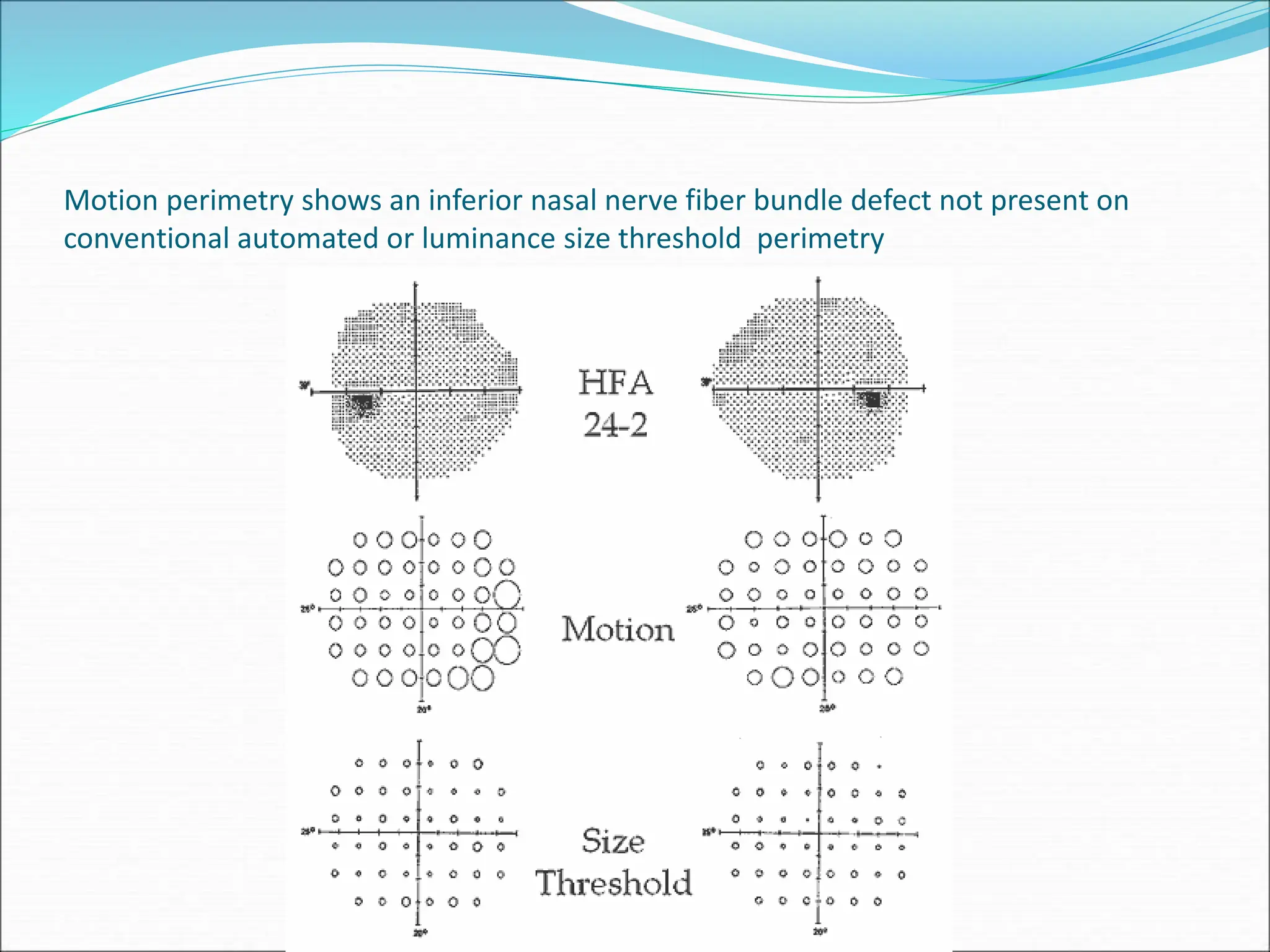 Motion perimetry shows an inferior nasal nerve fiber bundle defect not present on
conventional automated or luminance size threshold perimetry
 