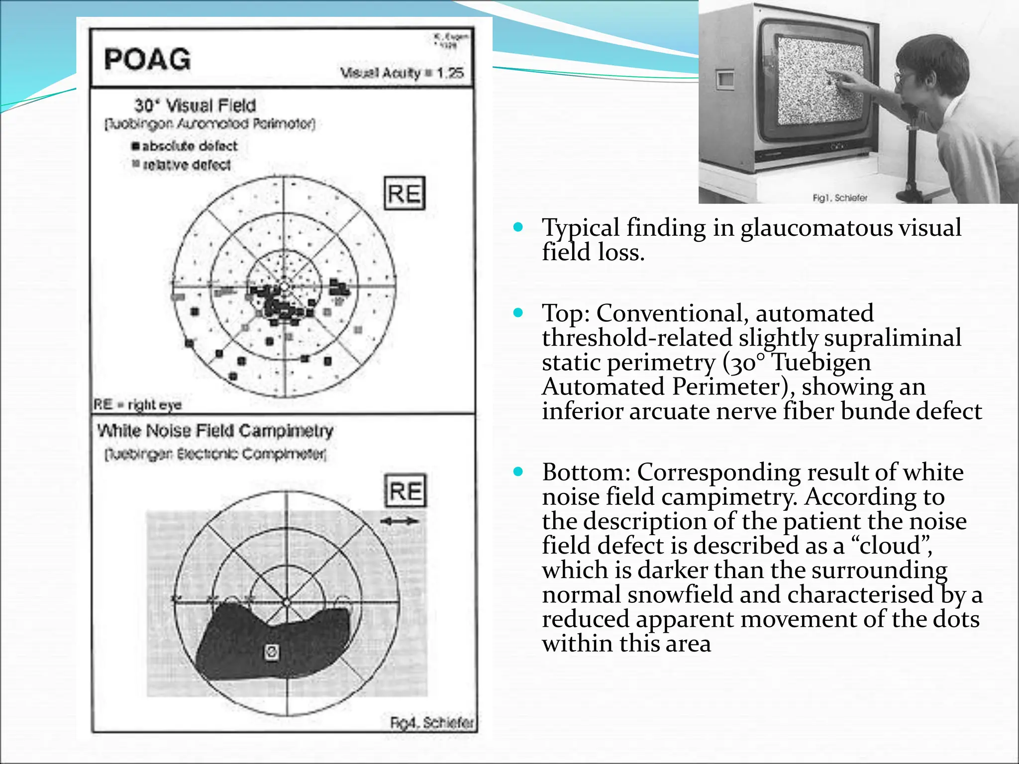  Typical finding in glaucomatous visual
field loss.
 Top: Conventional, automated
threshold-related slightly supraliminal
static perimetry (30° Tuebigen
Automated Perimeter), showing an
inferior arcuate nerve fiber bunde defect
 Bottom: Corresponding result of white
noise field campimetry. According to
the description of the patient the noise
field defect is described as a “cloud”,
which is darker than the surrounding
normal snowfield and characterised by a
reduced apparent movement of the dots
within this area
 
