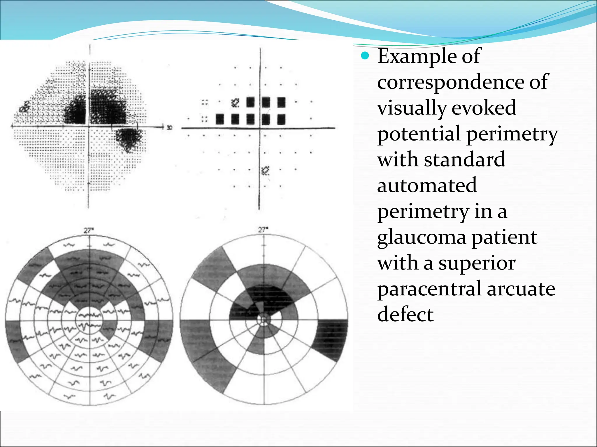  Example of
correspondence of
visually evoked
potential perimetry
with standard
automated
perimetry in a
glaucoma patient
with a superior
paracentral arcuate
defect
 