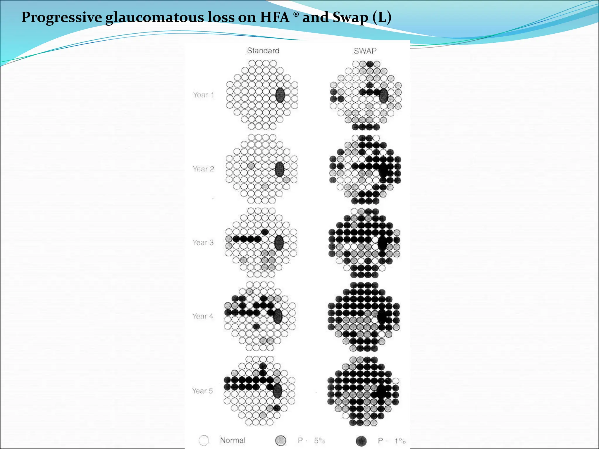 Progressive glaucomatous loss on HFA ® and Swap (L)
 