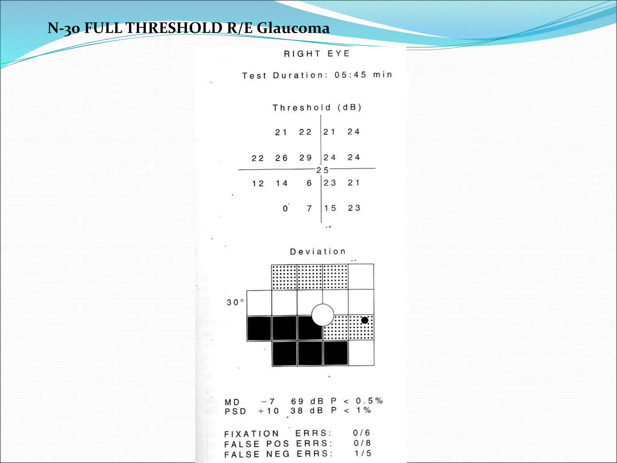 N-30 FULL THRESHOLD R/E Glaucoma
 