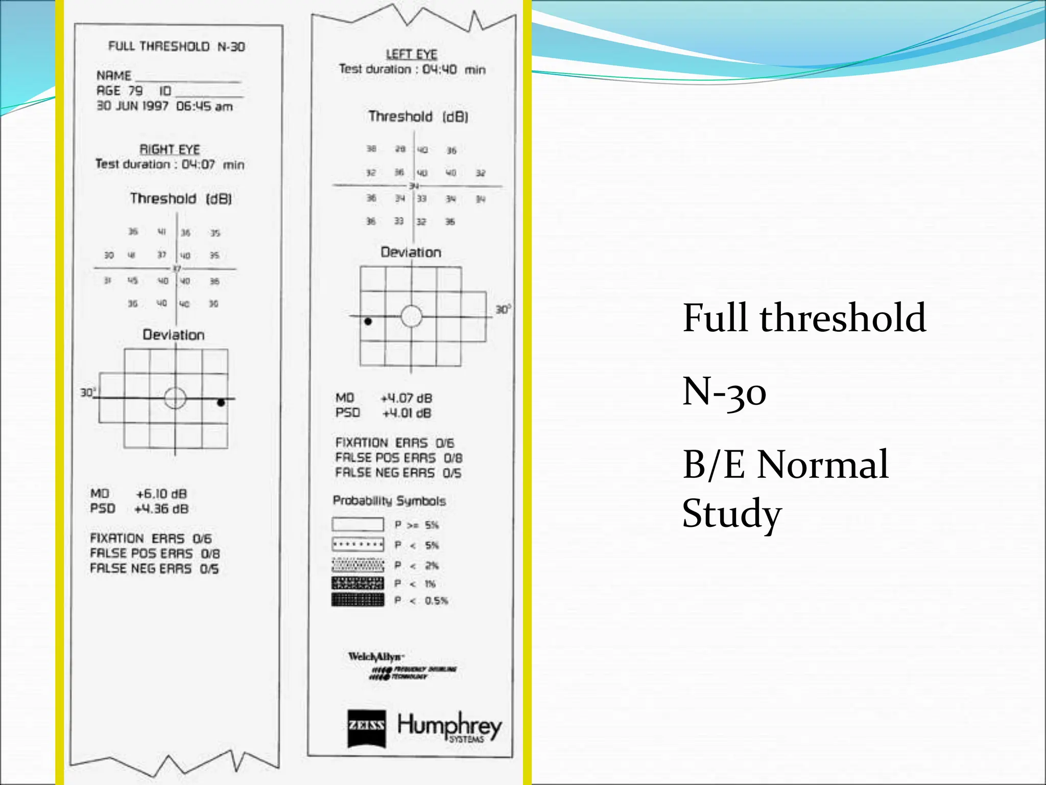Full threshold
N-30
B/E Normal
Study
 