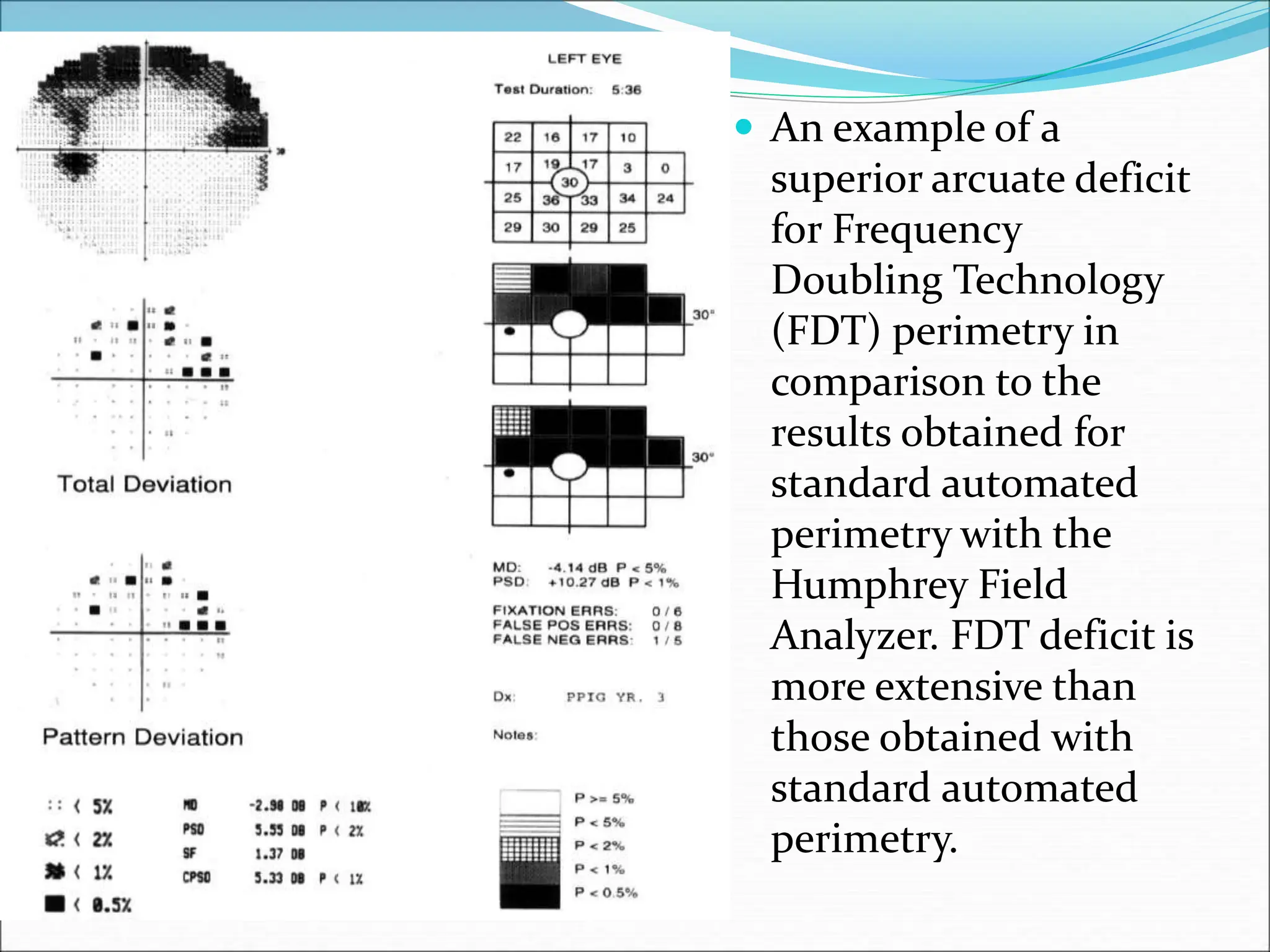  An example of a
superior arcuate deficit
for Frequency
Doubling Technology
(FDT) perimetry in
comparison to the
results obtained for
standard automated
perimetry with the
Humphrey Field
Analyzer. FDT deficit is
more extensive than
those obtained with
standard automated
perimetry.
 