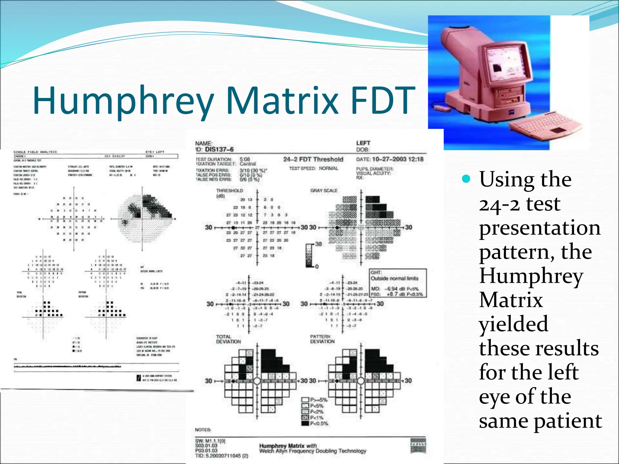 Humphrey Matrix FDT
 Using the
24-2 test
presentation
pattern, the
Humphrey
Matrix
yielded
these results
for the left
eye of the
same patient
 