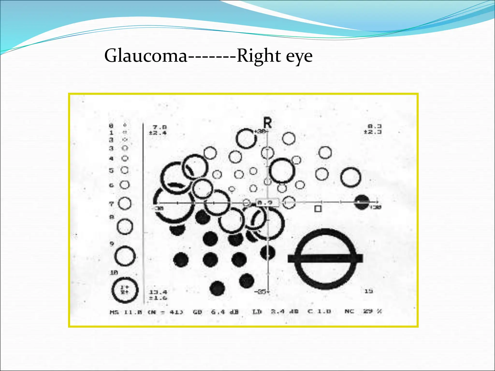 Glaucoma-------Right eye
 
