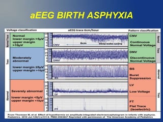 aEEG BIRTH ASPHYXIA
 