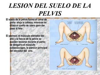 LESION DEL SUELO DE LA
PELVIS
El suelo de la pelvis forma el canal de
parto aloja la cabeza, mientras se
dilata el cuello de útero para dar
paso al feto .
El perineo, el músculo elevador del
ano y la fascia de la pelvis se
pueden lesionar durante el parto;
se desgarra el músculo
pubococcigeo, la porción principal
del elevador del ano.
 