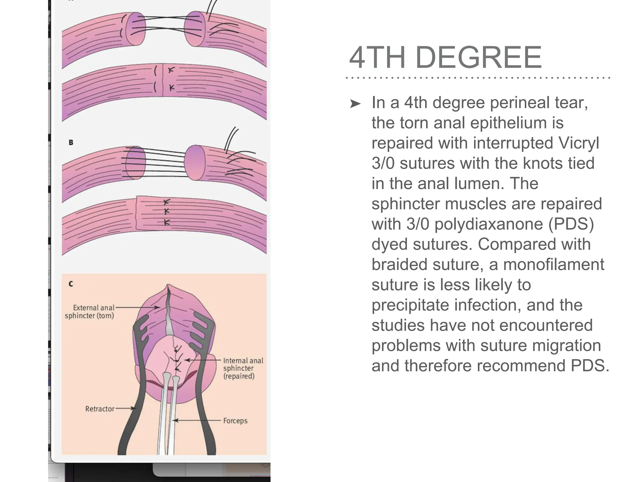 RISK FACTORS,EVALUATION AND MANAGEMENT OF PERINEAL TEARS | PPT