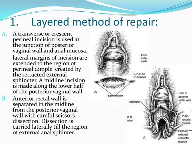 Perineal Lacerations perineal-lacerations