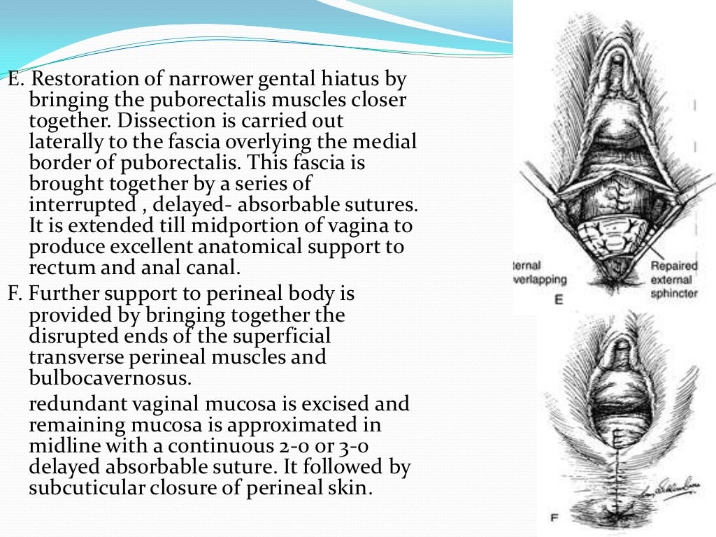 Perineal lacerations