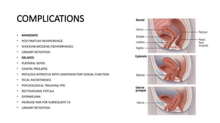 COMPLICATIONS
• IMMEDIATE
POST-PARTUM HEMMORHAGE
SHOCK(NEUROGENIC/HEMORRHAGIC)
URINARY RETENTION
• DELAYED
PUEPERAL SEPSIS
GENITAL PROLAPSE
PATULOUS INTROITUS WITH UNSATISFACTORY SEXUAL FUNCTION
FECAL INCONTINENCE
PSYCHOLOGICAL TRAUMA& PPD
RECTOVAGINAL FISTULA
DYSPAREUNIA
INCREASE RISK FOR SUBSEQUENT CS
URINARY RETENTION
 