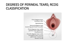 DEGREES OF PERINEAL TEARS; RCOG
CLASSIFICATION
 