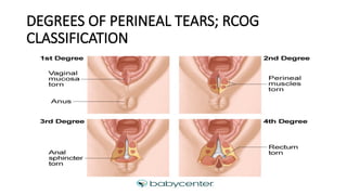 DEGREES OF PERINEAL TEARS; RCOG
CLASSIFICATION
 