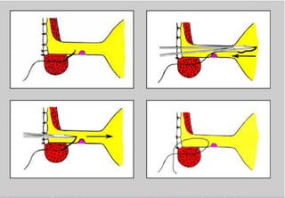 Perineal urethrostomy