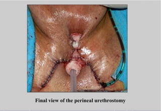 Perineal urethrostomy