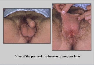 Perineal urethrostomy