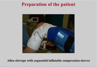 Perineal urethrostomy