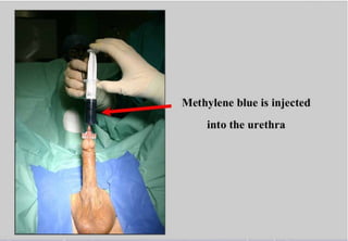 Perineal urethrostomy