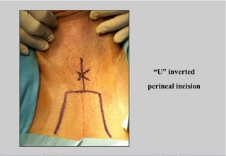 Perineal urethrostomy