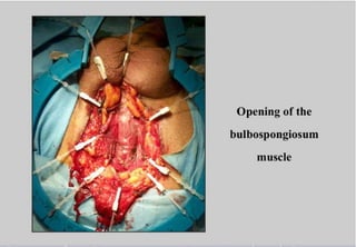 Perineal urethrostomy