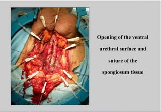 Perineal urethrostomy
