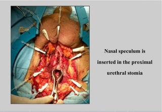 Perineal urethrostomy
